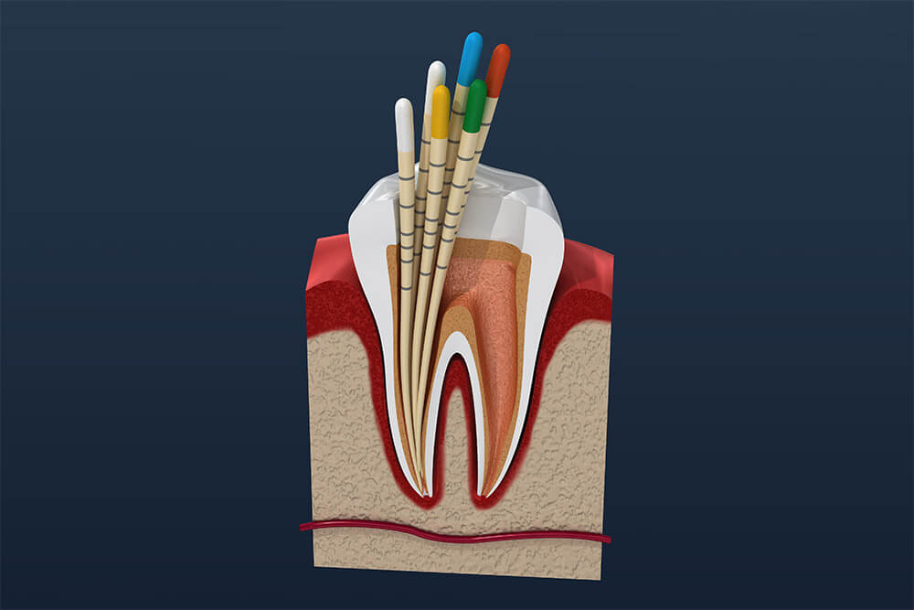 Root Canal Treatment
