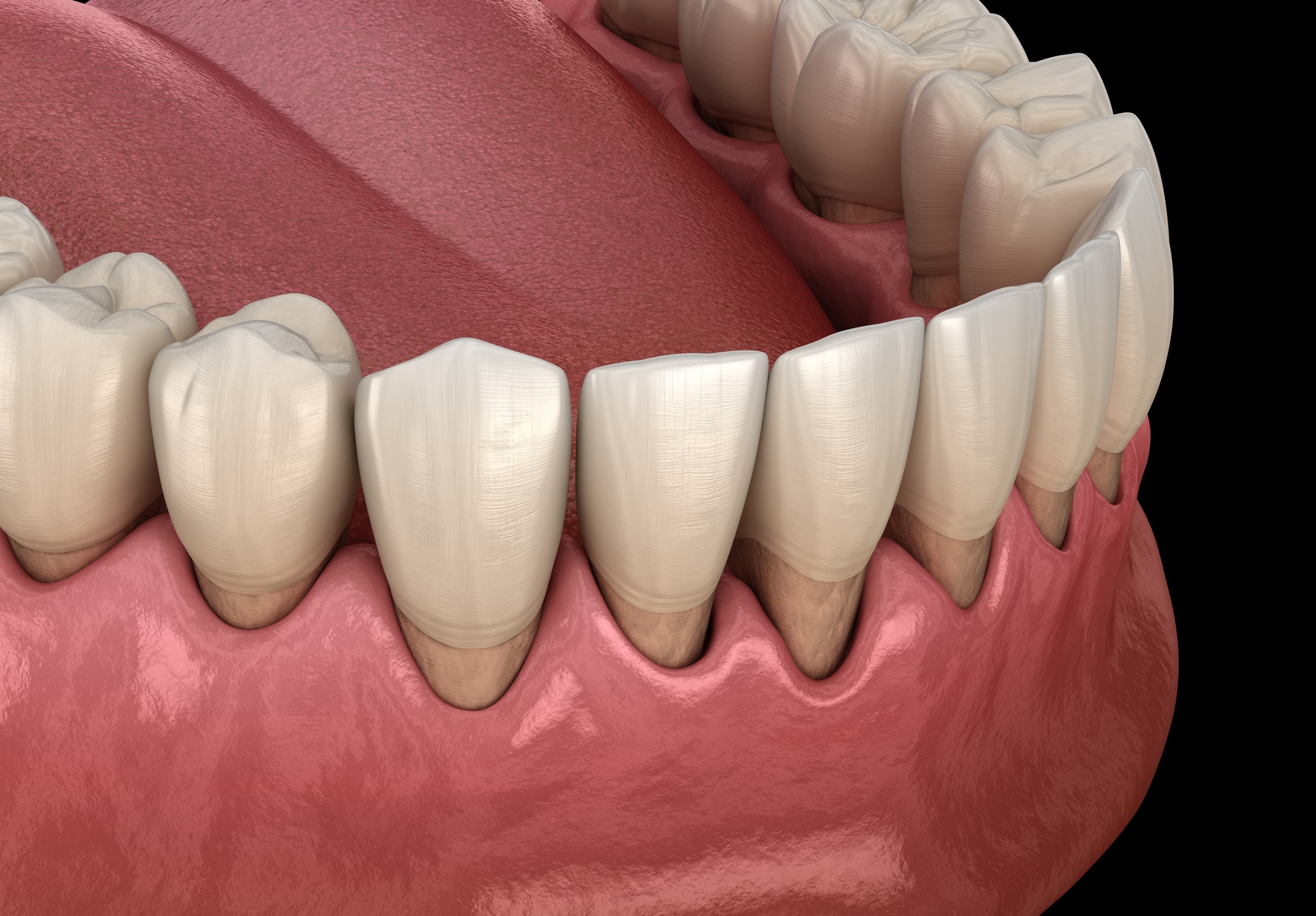 Gum Disease Treatment