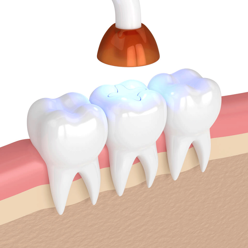 Cavity Fillings and Sealants