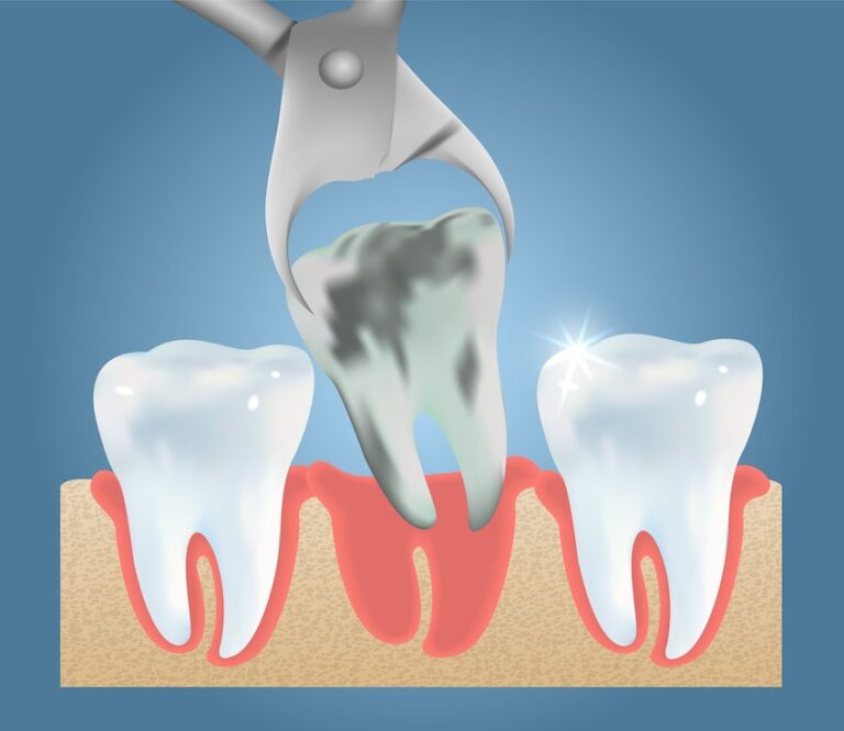 Illustration of a dental extraction with a decayed tooth being pulled between two healthy teeth