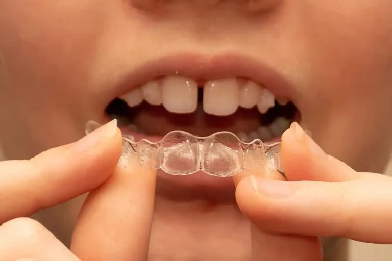 Clear Braces